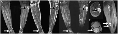 18F-FDG PET/CT revealed sporadic schwannomatosis involving the lumbar spinal canal and both lower limbs: a case report